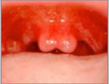 bifid uvula