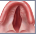 Cleft palate