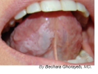 Leukoplakia